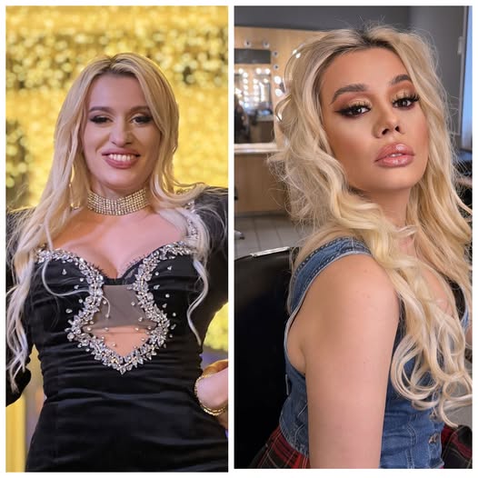 Anisia Gafton, sinceră despre operația la nas: „Îmbinarea dintre estetic și sănătate a fost alegerea corectă pentru mine”.Vezi in comentarii
