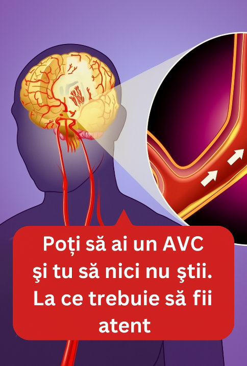 Poți să ai un AVC și tu să nici nu știi. La ce trebuie să fii atent