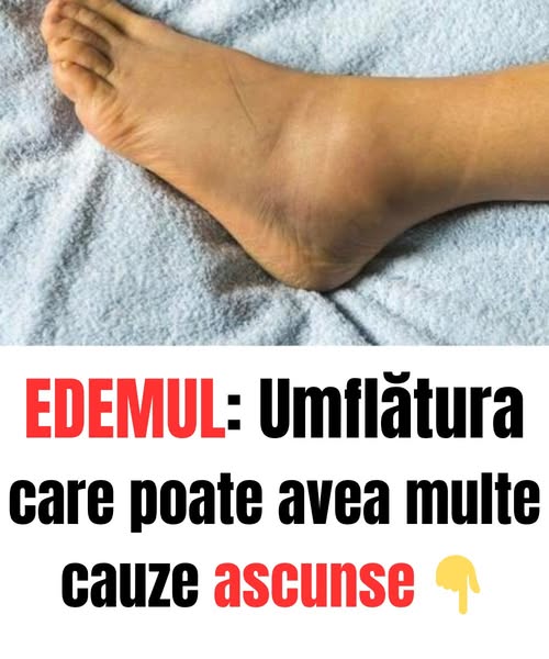 Acesta este un semn că ceva nu este în regulă. Ce trebuie să știi despre umflături ⬇️ Citește mai mult în primul comentariu👇