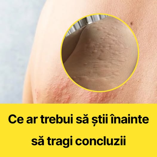 Dacă îți apare asta pe piele, este unul dintre semnele de hi…